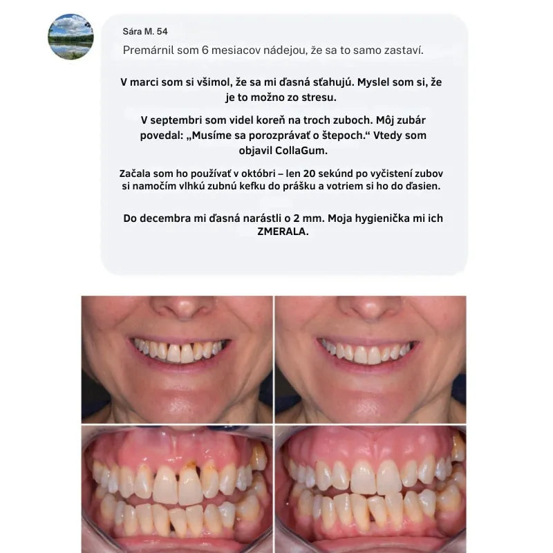 Collagen Powder for Gums